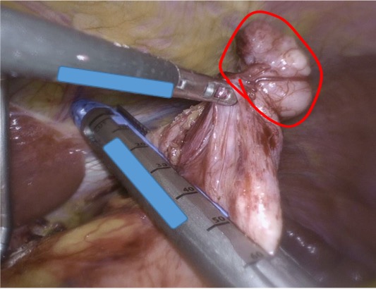 Chirurgischer Eingriff im Bauchraum mit medizinischen Instrumenten, ein Organ oder Gewebe wird umkreist.