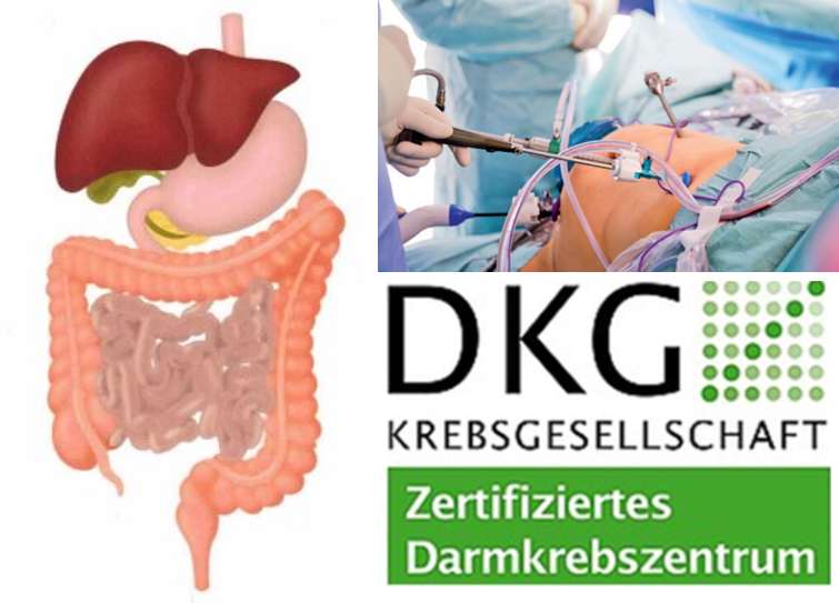 Illustration des Verdauungssystems, OP-Szene und DKG-Zertifizierungslogo für Darmkrebszentrum.