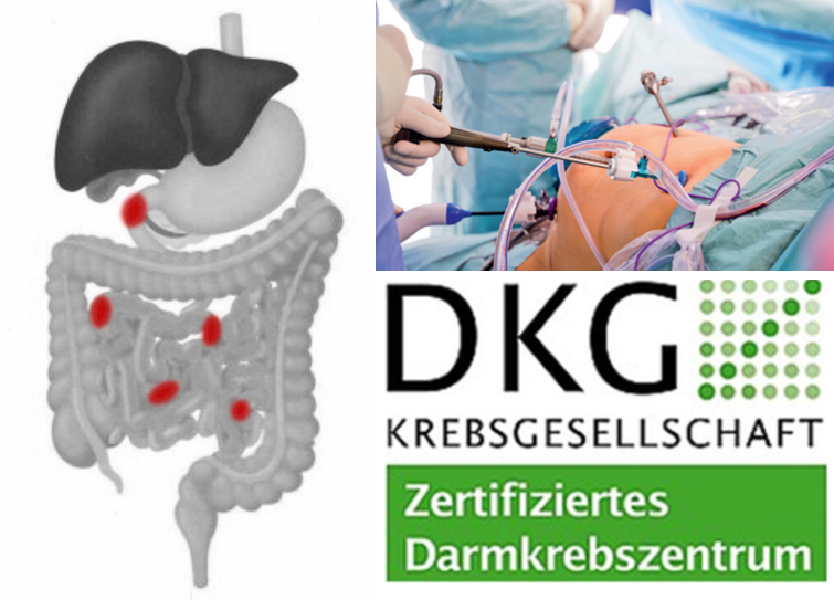 Grafik zeigt Magen-Darm-System, OP-Szene und Logo der DKG für zertifizierte Darmkrebszentren.