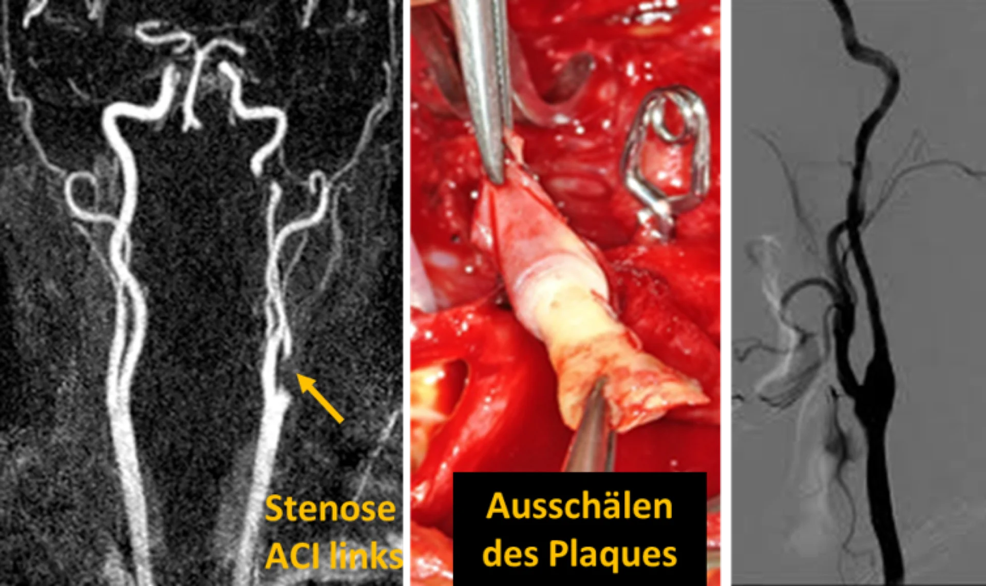 Drei Bilder: Arterienstenose links, chirurgische Entfernung von Plaques, post-OP Arterie ohne Stenose.