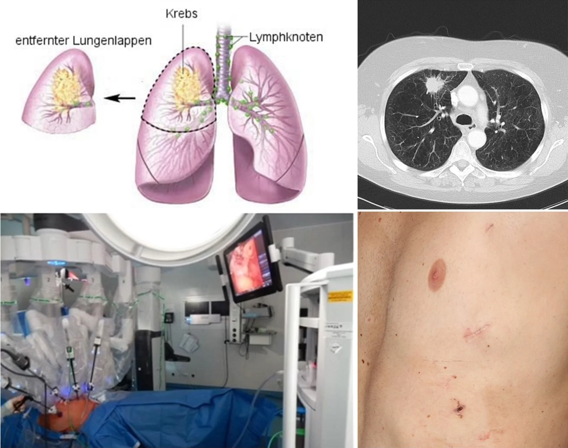 Lunge-Brustkorb-Mittelfell-Mediastinum Collage: Diagramm einer Lungenkrebs-OP, CT-Scan der Lunge, Operationssaal mit Roboter, Narben am Oberkörper einer Person.