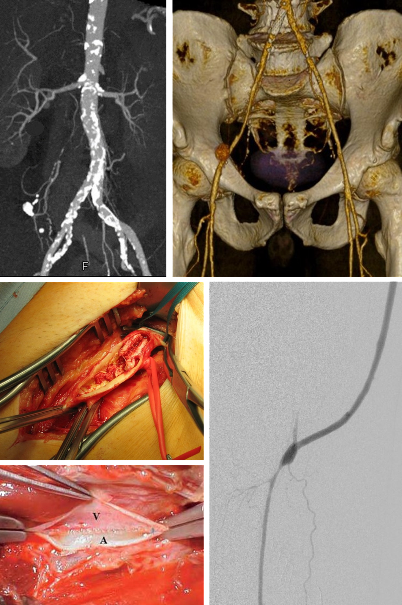 Periphere-arterielle-Verschlusskrankheit Medizinische Bildgebung und Chirurgie: Aortenstent, chirurgische Eingriffe, angiographische Darstellung einer Arterie.