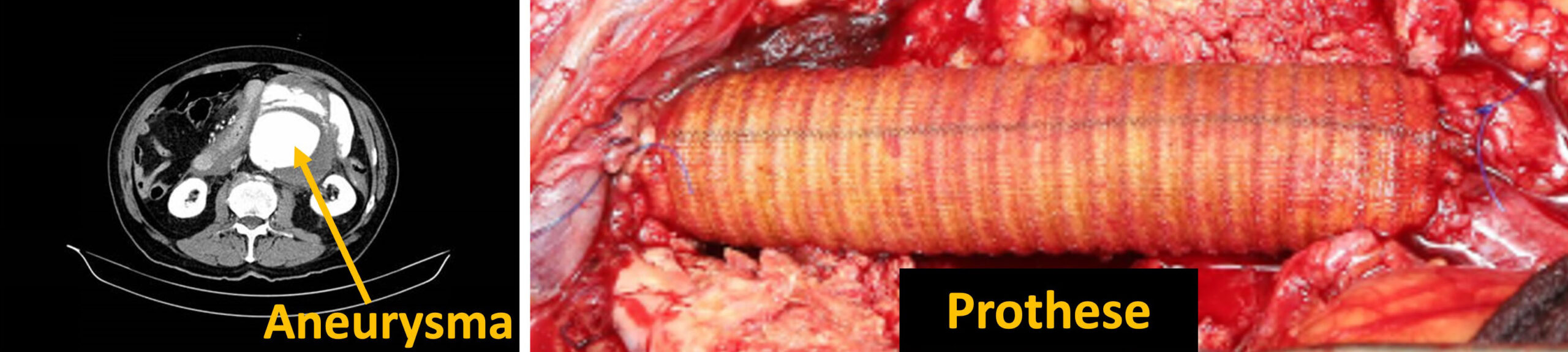 CT-Bild: Aneurysma markiert. Chirurgische Aufnahme: Implantierte Gefäßprothese zu sehen.