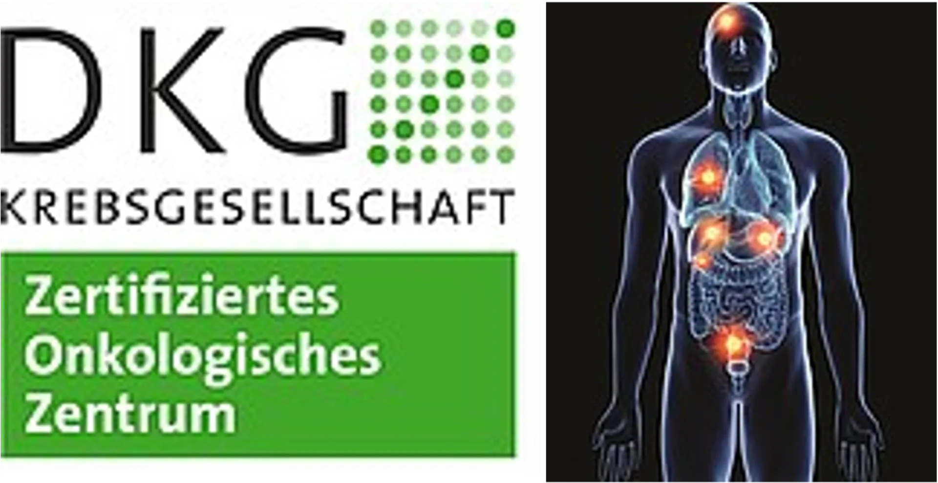 Logo der DKG und schematische Darstellung eines menschlichen Körpers mit markierten Tumorstellen.
