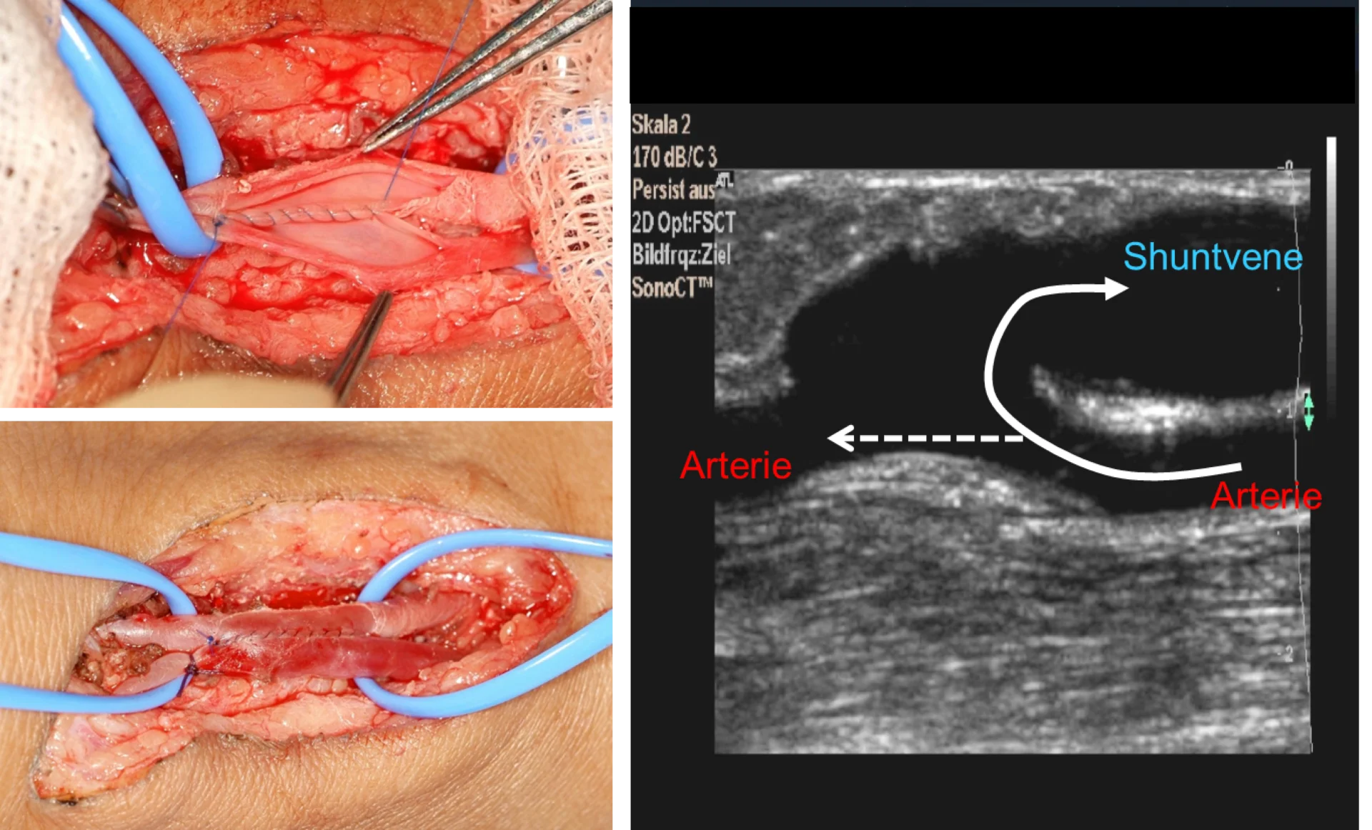 Chirurgische Ansicht von Arterie und Shuntvase mit Ultraschallbild rechts, zeigt Venen-Arterien-Verbindung.