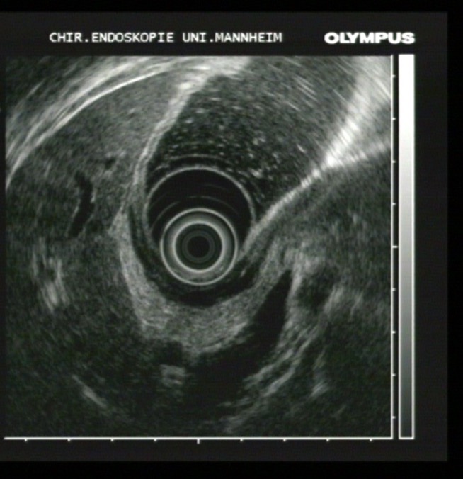 Endoskopisches Ultraschallbild einer zylindrischen Struktur, erstellt mit einem Gerät von Olympus, beschriftet mit Uniklinik Mannheim.